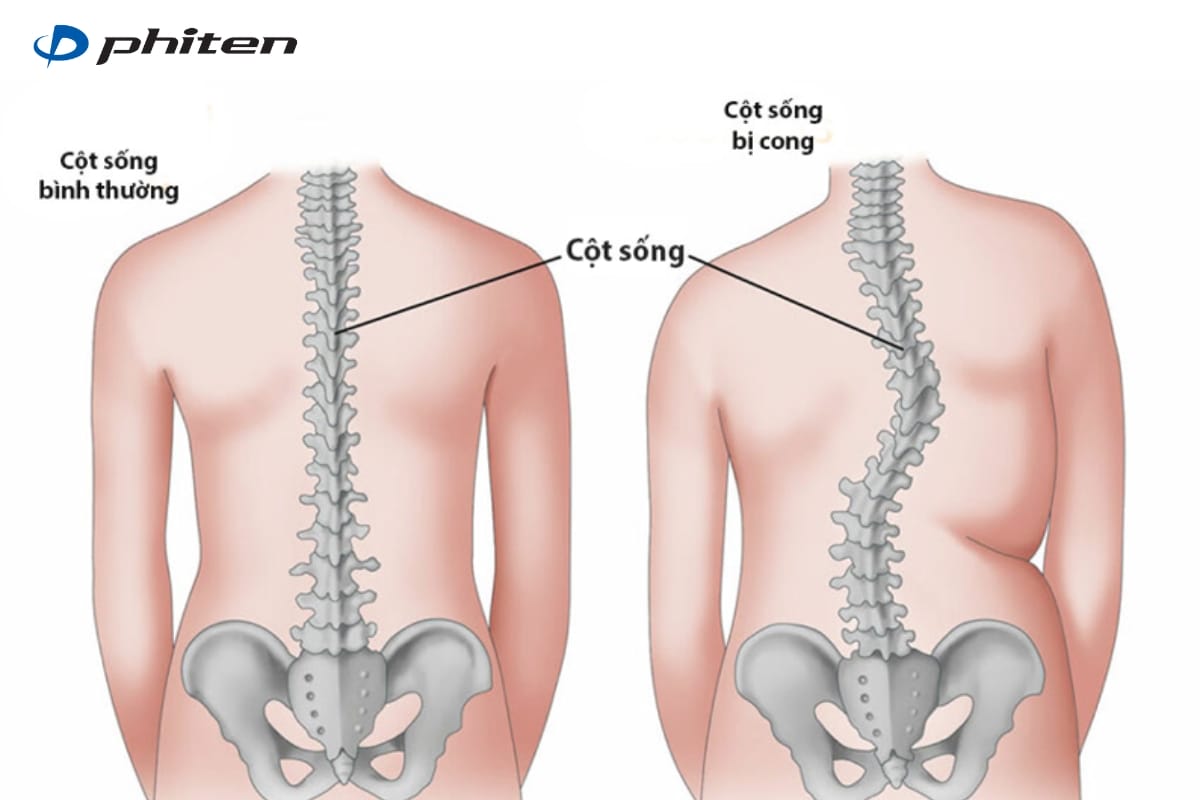 béo phì gây bệnh về cột sống