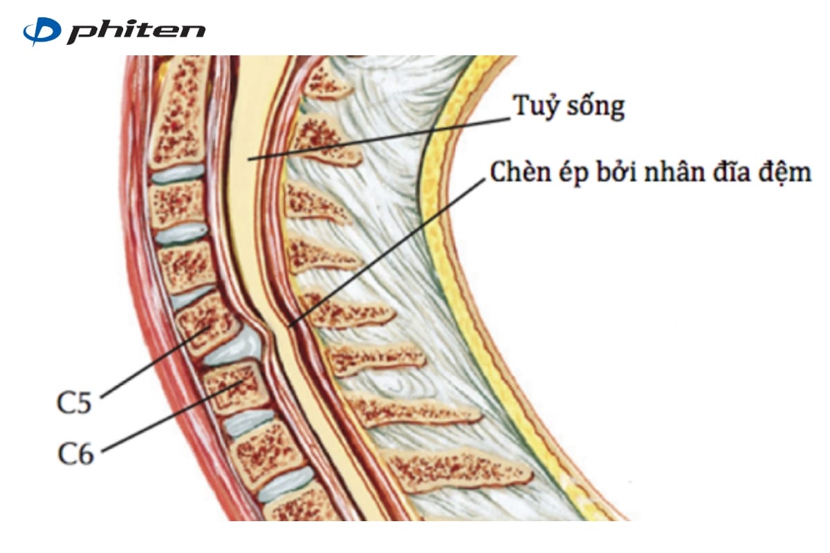 chấn thương tuỷ sống