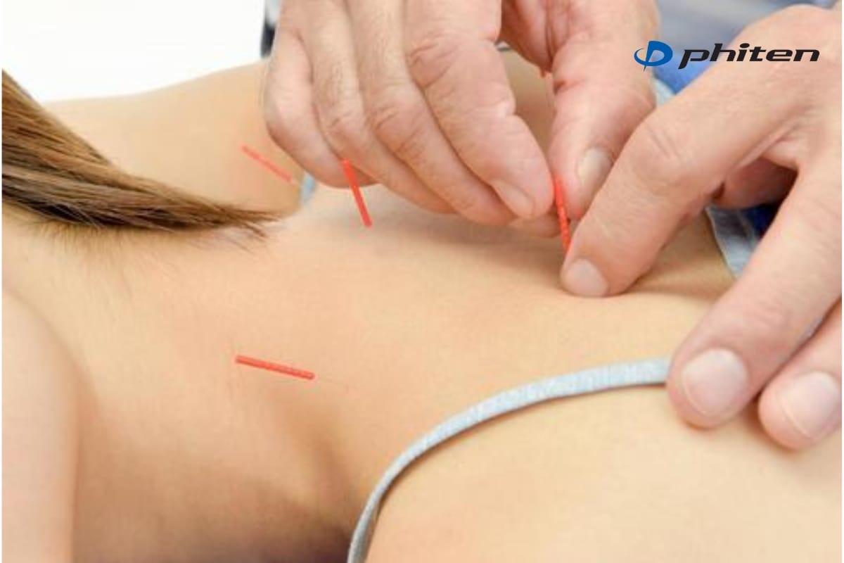 châm cứu là một trong những cách điều trị đau cổ vai gáy của nhật