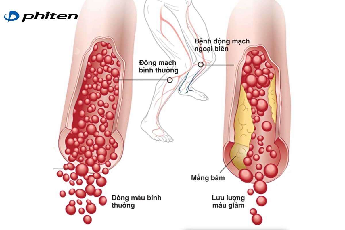 Rối loạn mạch máu chi dưới