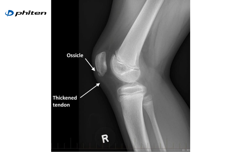 các bệnh lý gây đau đầu gối ở người trẻ
