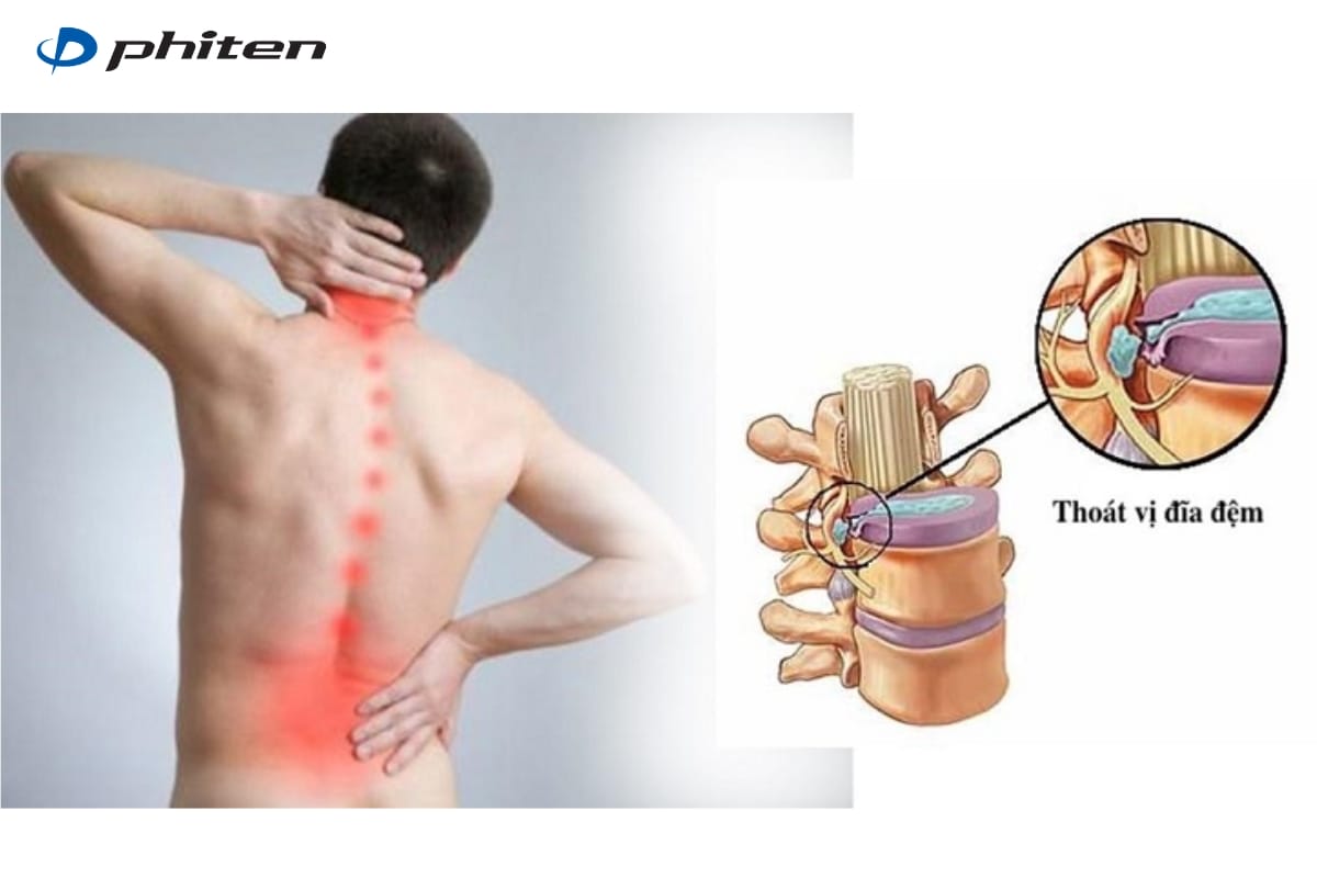 thoát vị đĩa đệm