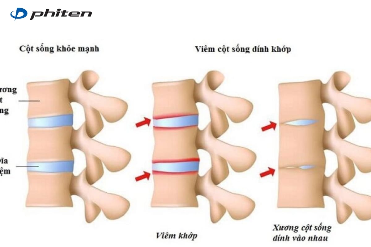 viêm cột sống dính khớp