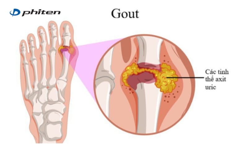 bệnh gout gây đau đầu gối khi đứng lên ngồi xuống