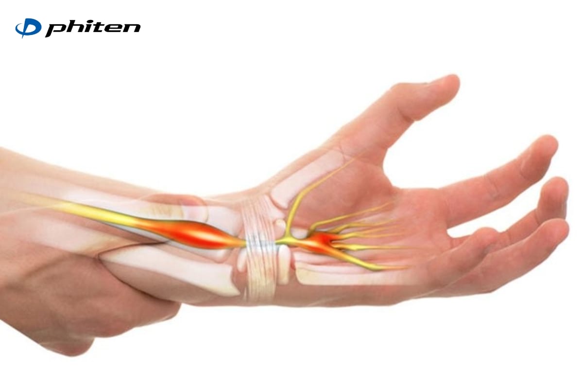 hội chứng ống cổ tay chèn ép dây thần kinh ngoại biên