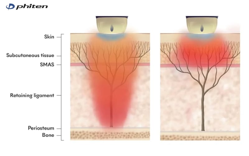 ứng dụng của titanium lifting