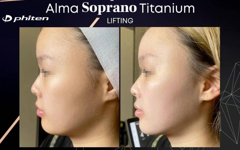 nâng cơ mặt titanium