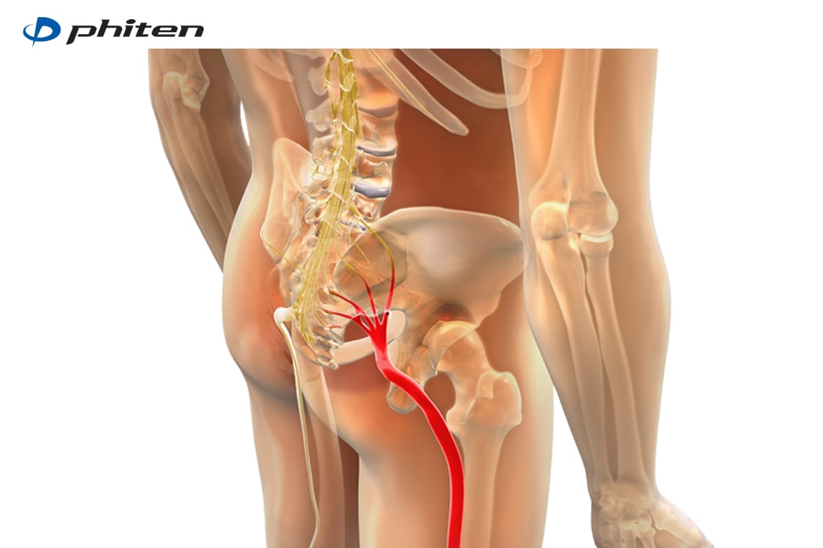 đau thần kinh toạ