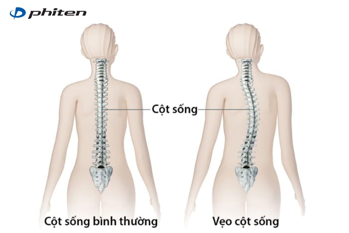 vẹo cột sống