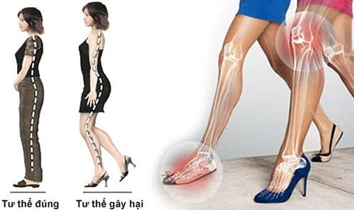 Tác hại nguy hiểm của giày cao gót tới xương khớp