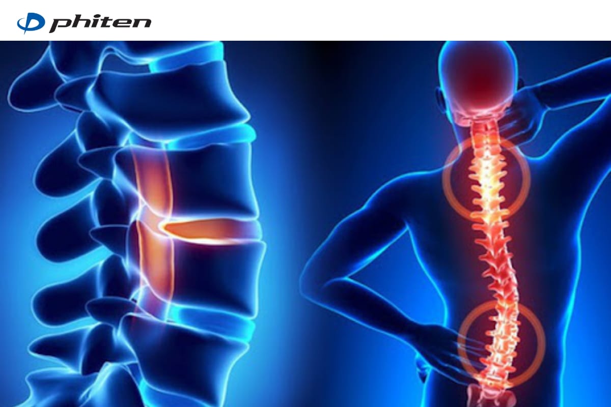 thoái hoá cột sống