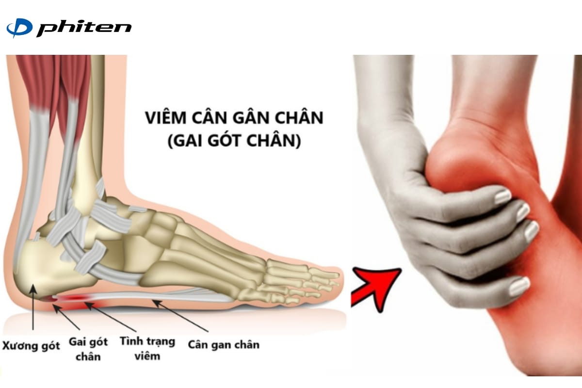 Viêm cân gan chân