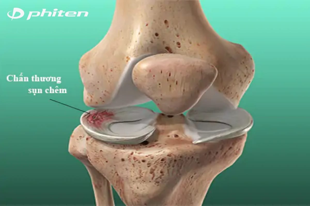 tổn thương sụn chêm gây đau đầu gối khi chơi thể thao