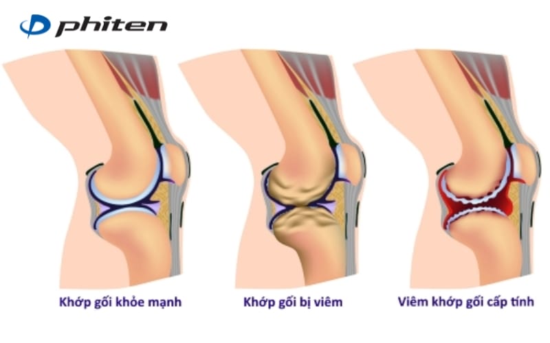 viêm nhiễm khớp gối gây đau khi đi lại