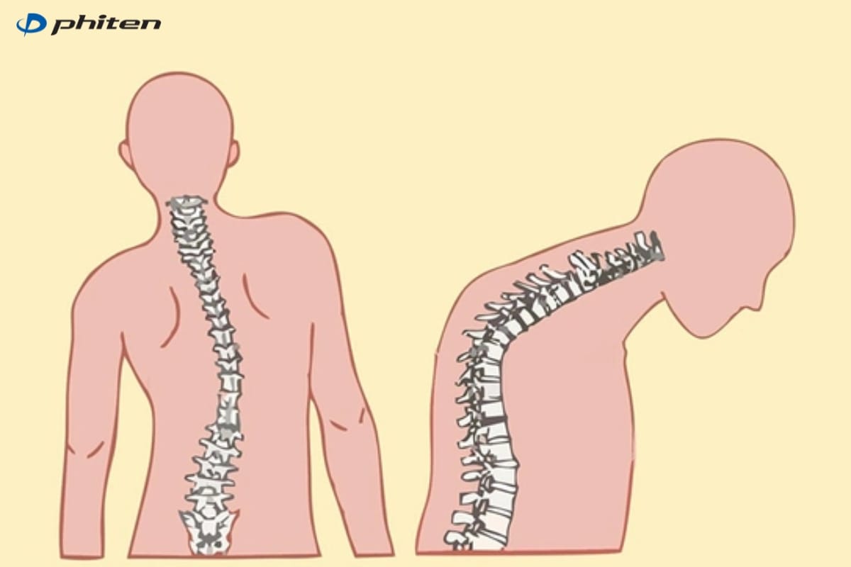 trẻ bị gù lưng nặng